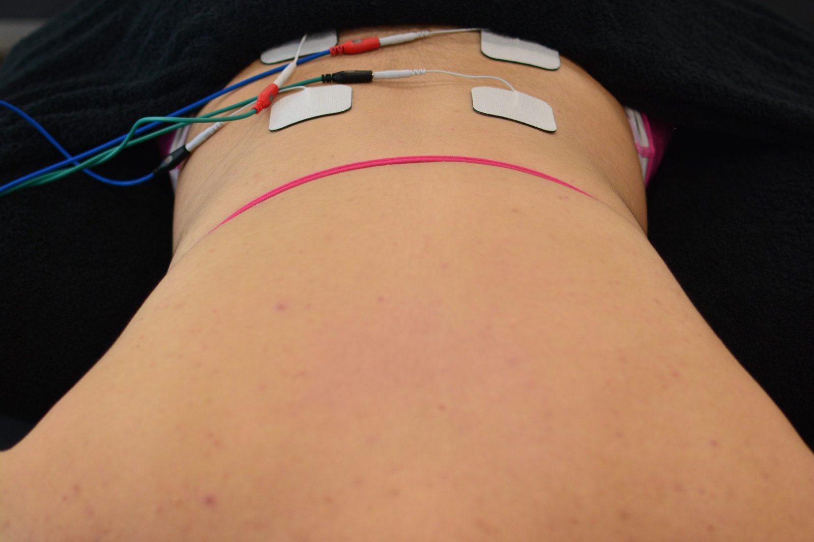 Electrode therapy treatment in progress at the Axis33 clinic